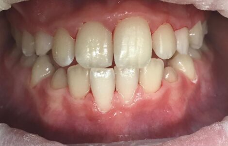 Pacient na dentálnej hygiene v zubnej ambulancii v Nitre