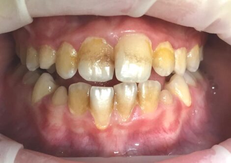 Profesionálna dentálna hygiena v Nitre – odstránenie zubného kameňa